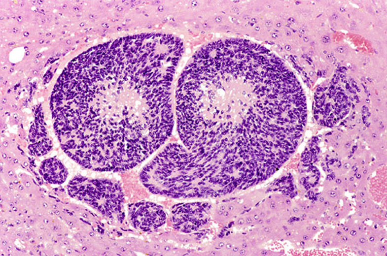 Hepatoblastoma cells