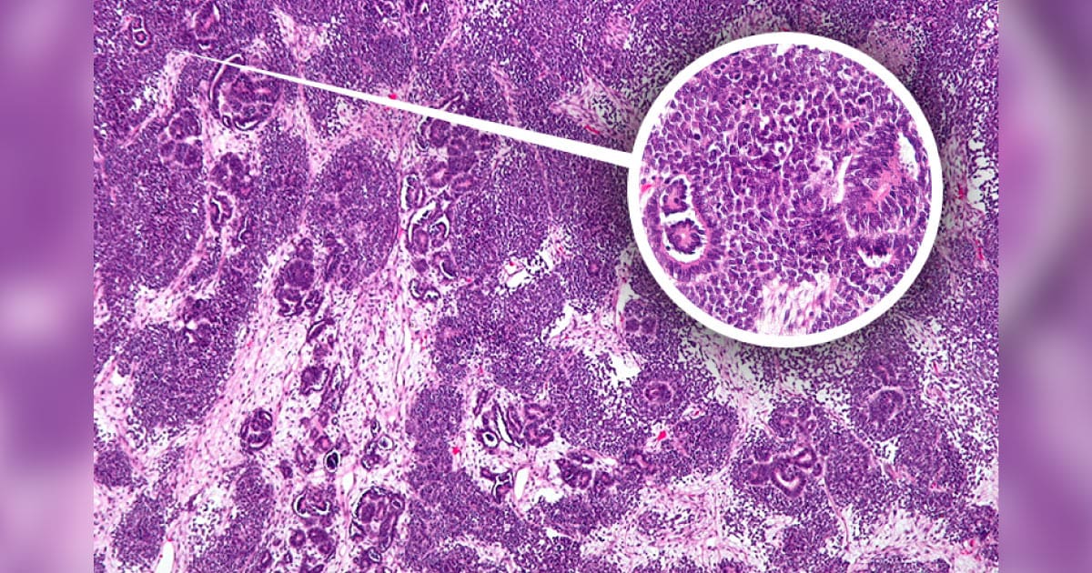 Wilms tumor cell as seen in the kidney.