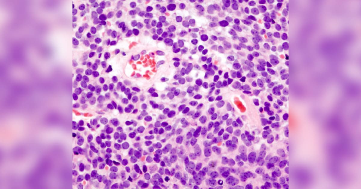 Medulloblastoma cells. 