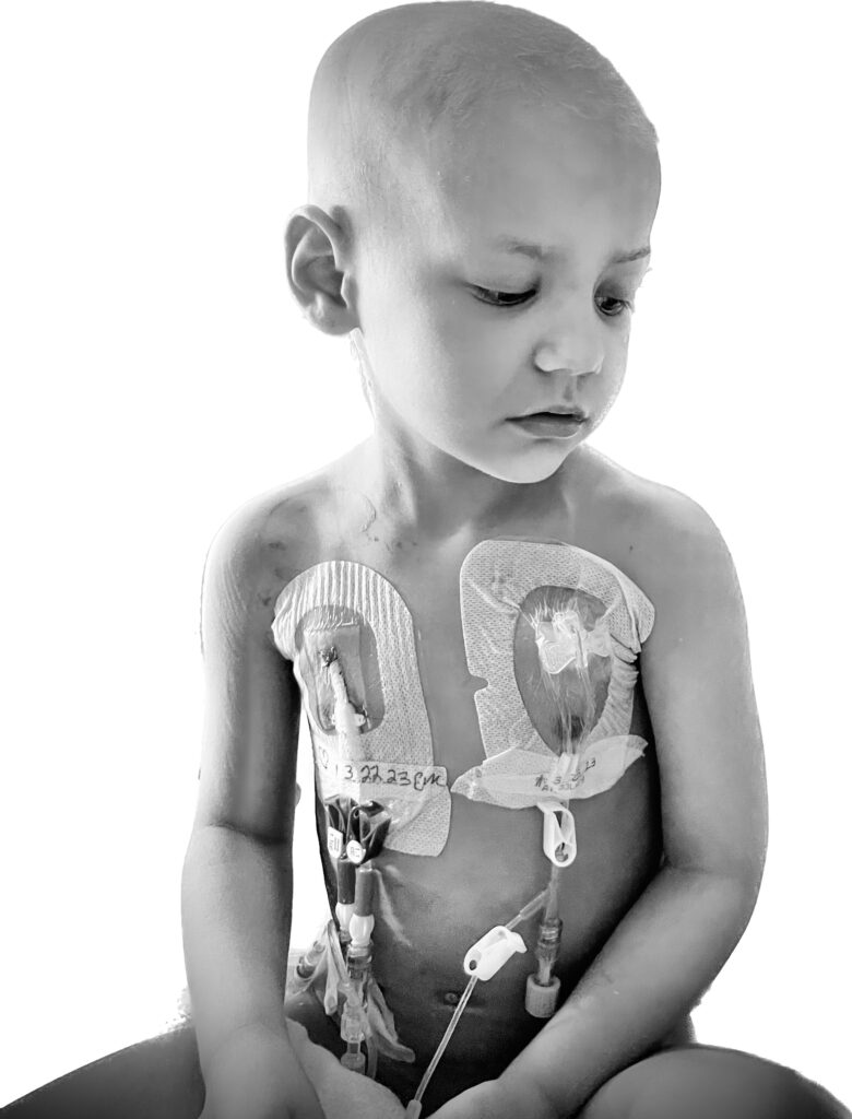black and white photo of cancer warrior Julianna with various medical ports on her body during her cancer treatment