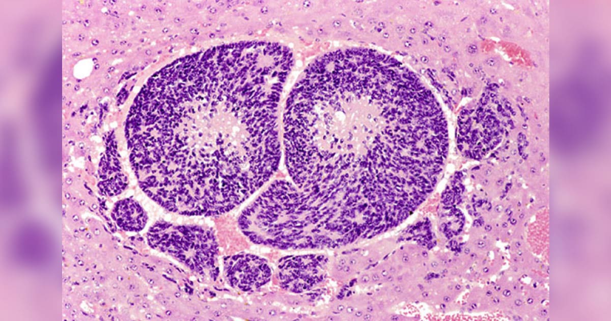 Hepatoblastoma cell 