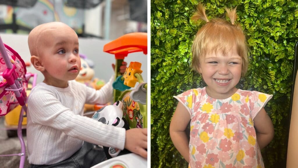 Before and after comparison of Lilah, showing her during AT/RT treatment without hair and after recovery smiling with regrown hair in pigtails.